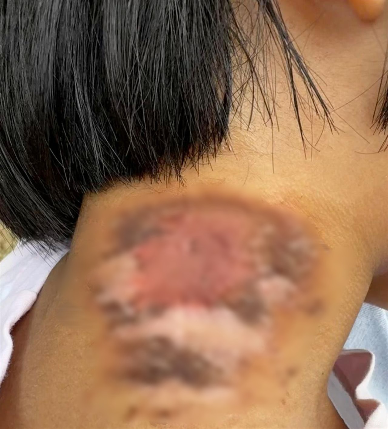 王女士女兒的傷口（圖源：受訪者提供）