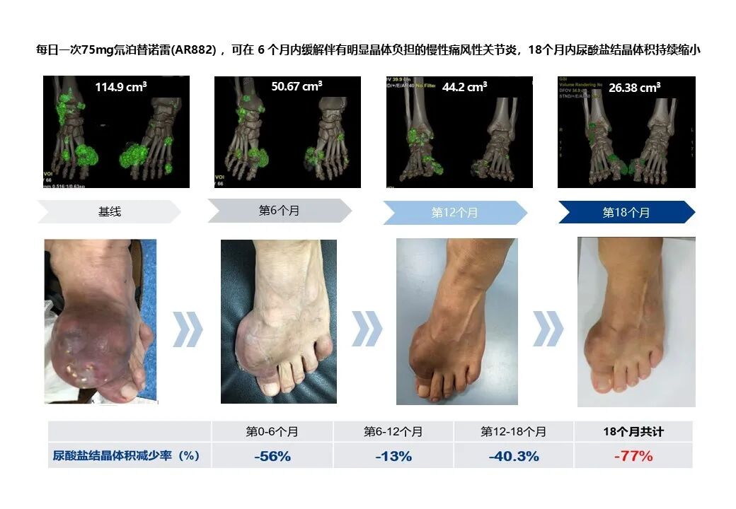 氘泊替诺雷(AR882)治疗尿酸盐结晶体积持续缩小示意图