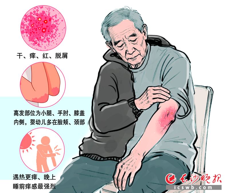 冬天洗澡后身上发痒 小心干性湿疹