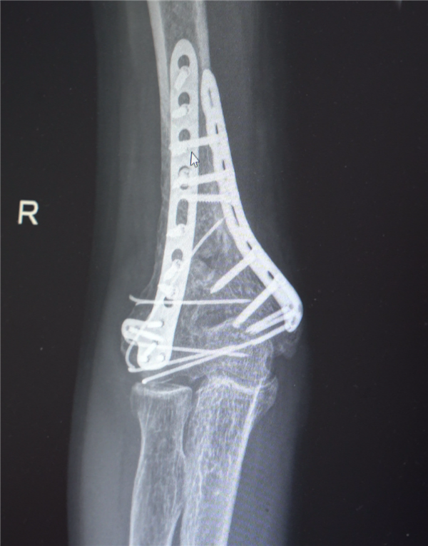 部分手术后拍摄的影像