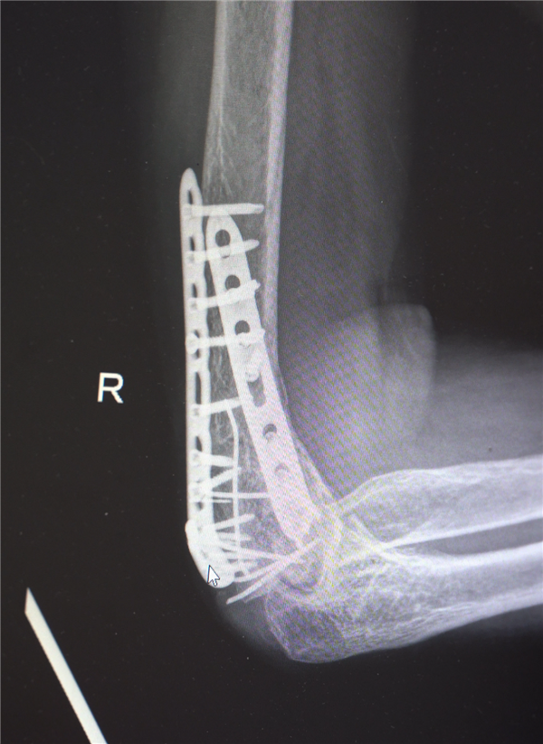 部分手术后拍摄的影像