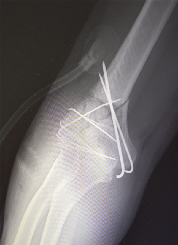 部分手术后拍摄的影像