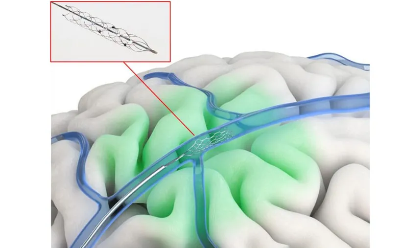 　　图：核心产品Stentrode示意图，来源：开源证券