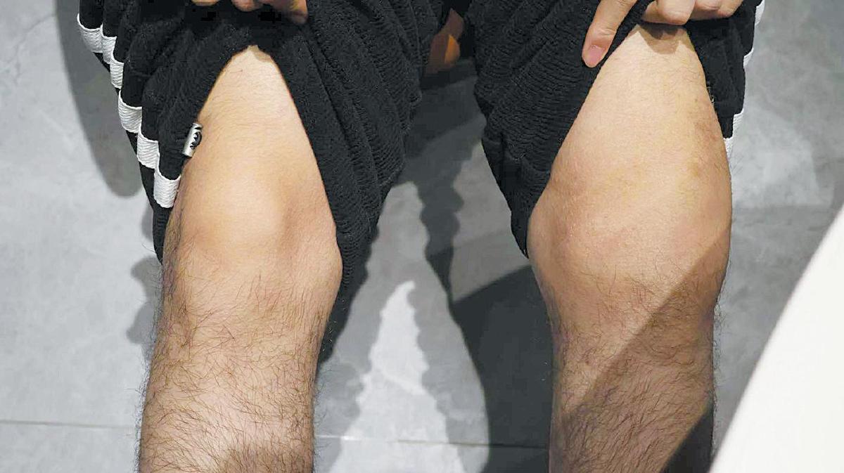 叶胜乐左腿膝盖肿胀，医生判断为出血。 A10-A11版摄影/新京报记者　黄依琳