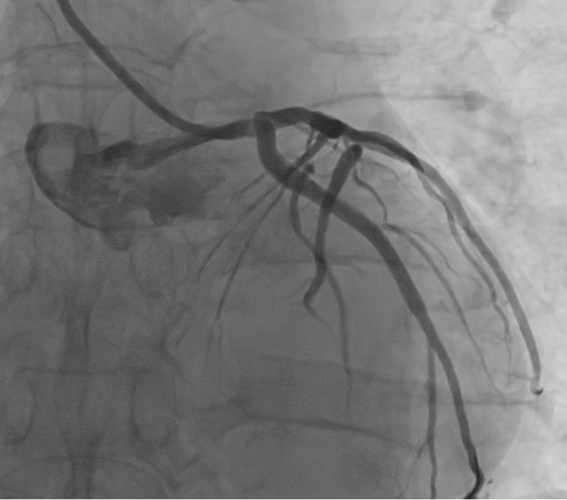 术后冠脉造影，回旋支支架术后未见狭窄