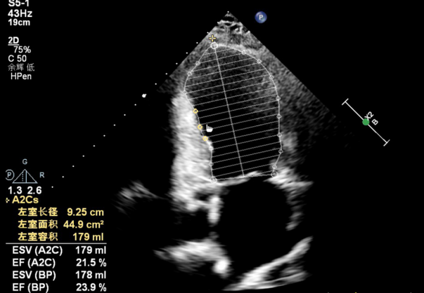 △ 患者术前心脏超声图