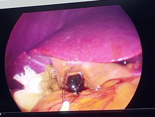 △腹腔镜下,结石正在被取出