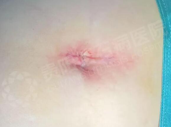 △患者术后脐部照片