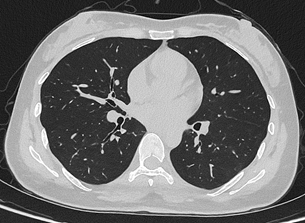 联影uCT Ultima扫描的0.2mm肺部超高清成像，扫描剂量低至0.1mSv
