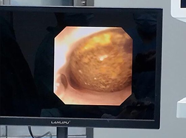 △ 精准定位结石