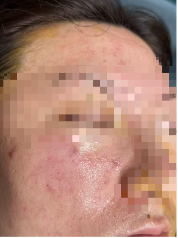 演员李现发文：花粉过敏快折磨死我了！眼下正高发，有人洗个热水脸红一整天