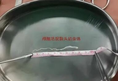 脑袋里“挖”出8厘米活虫！这个“土方子”害人不浅，很多人还在用！
