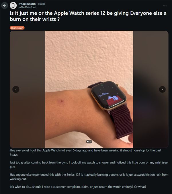 苹果Apple Watch S12被曝引发皮肤不适!有用户佩戴后手腕发红、出现灼烧感 苹果Apple Watch S12被曝引发皮肤不适!有用户佩戴后手腕发红、出现灼烧感