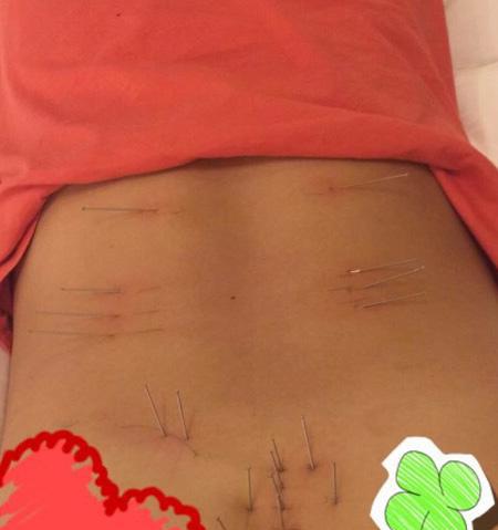 彭帅在微博上晒出针灸治疗照片。