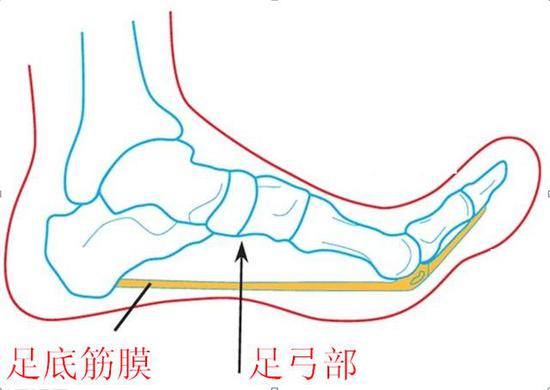 足底筋膜炎