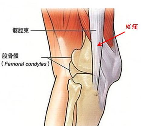 髂胫束疼痛