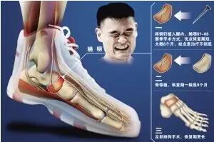 7种跑步伤病提早预防轻松告别跑步膝跟腱炎