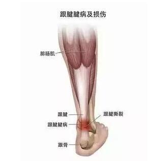 7种跑步伤病提早预防!轻松告别跑步膝跟腱炎