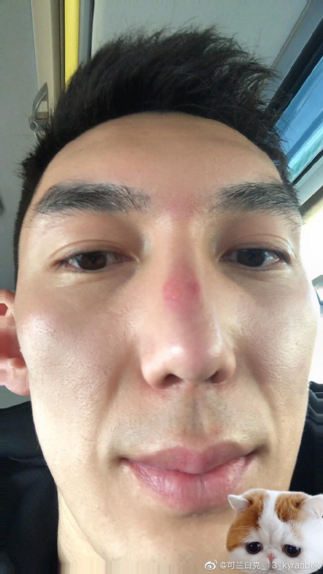可兰白克受伤