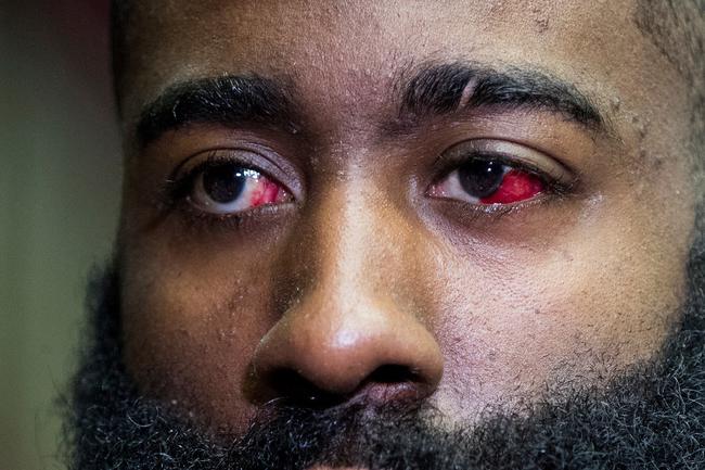 哈登眼睛傷勢疑似變嚴重,血塊已擴散一半眼球!-黑特籃球-NBA新聞影音圖片分享社區