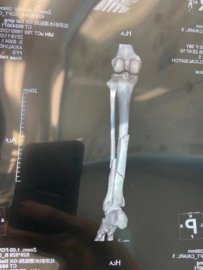 受害者最终诊断为右小腿胫骨骨折