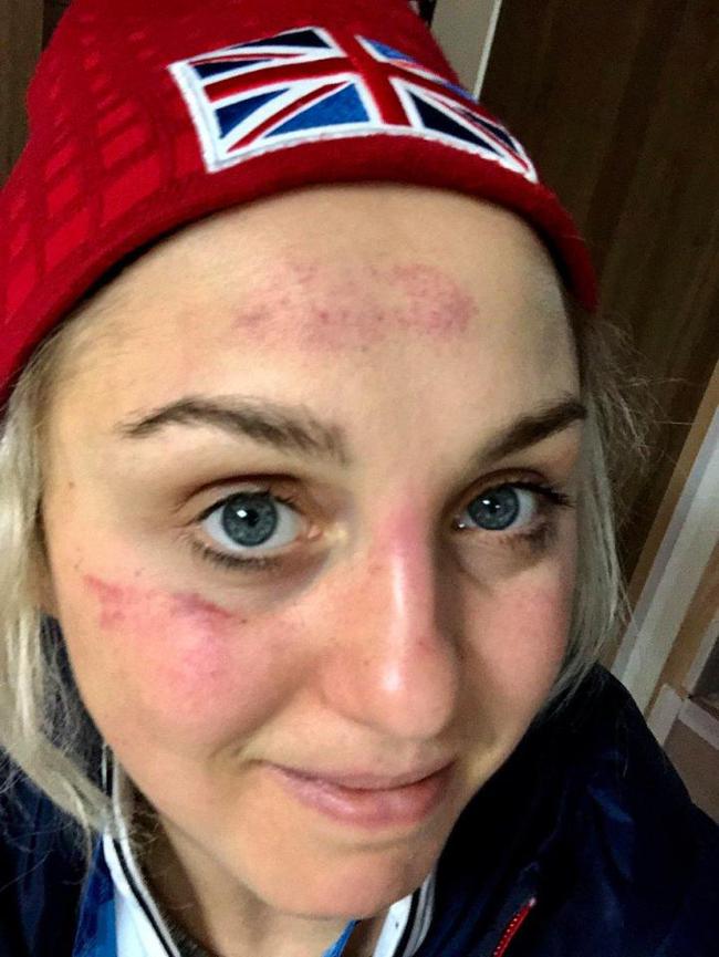 英国滑雪美女摔倒鼻青脸肿:像被拷打了一样(图)