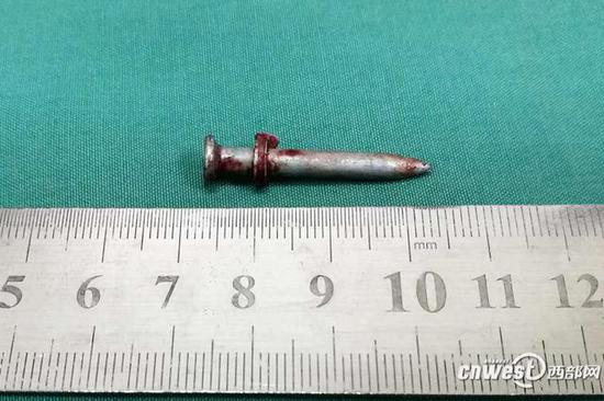 裝修工人李師傅在操作時,不慎將3厘米長的鋼釘從咽喉前方射入自己的頸部。