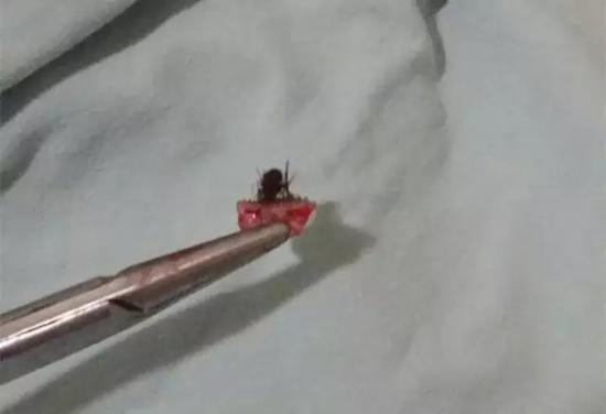西安市儿童医院:科学处理蜱虫叮咬
