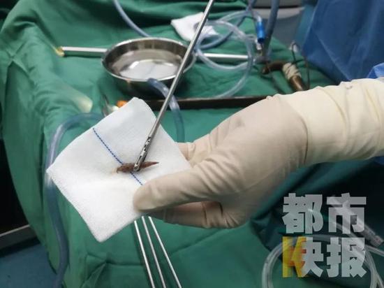 情况危急,医院立刻给安老太进行了手术,顺利取出了这个致命的枣核。