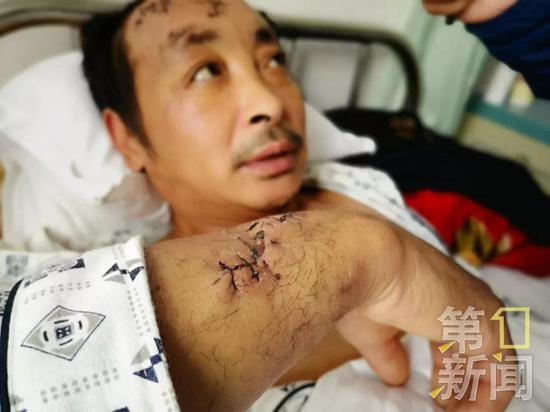 在被黑熊袭击的过程中,谭师傅头部,大腿接连被黑熊严重抓伤。伤口触目惊心!
