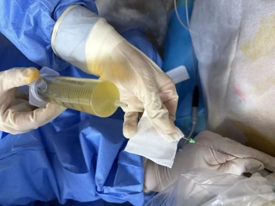 大囊一次抽吸50ml以上
