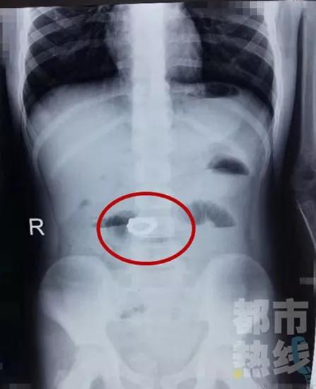 随后,张女士立即带孩子前往当地医院检查。