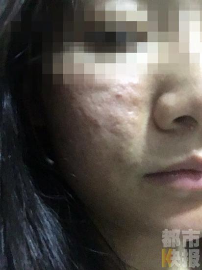 女子微整形打水光针满脸起疙瘩 “医生”:忘做皮试了