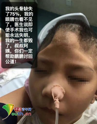 被虐待男童头骨损失75%，眼睛也看不见了。图片来源微博账号“呼唤鹏鹏”
