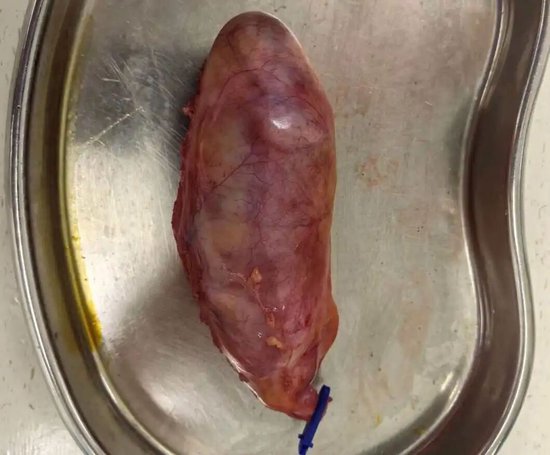 （宋女士的胆囊充满结石）