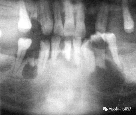 严重的根尖疾病