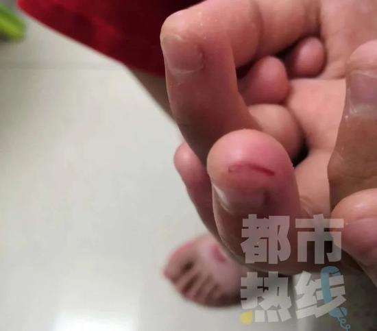 王女士:“血擦凈以后, 看見是一個長長的口子,流血流得很多。”