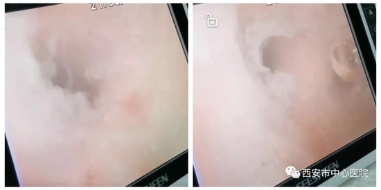  （图为镜下灌洗前）