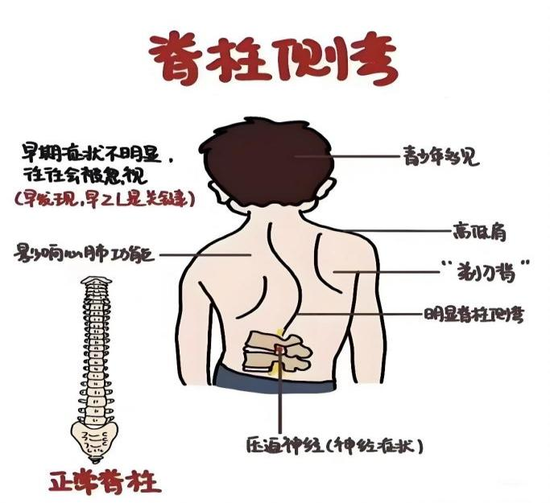 脊柱側彎圖示