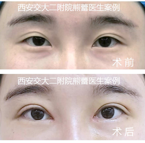 案例一:双眼皮修复+开眼角