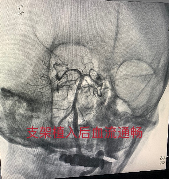 术后基底动脉血流通畅 