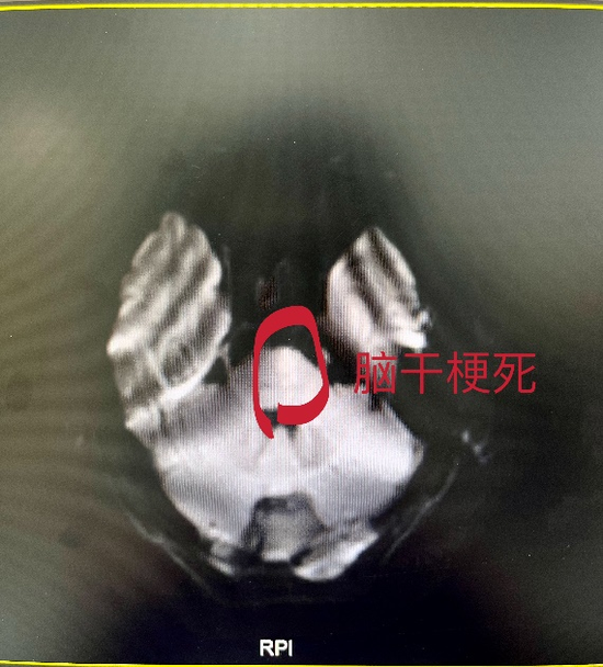 术前提示脑干梗死      