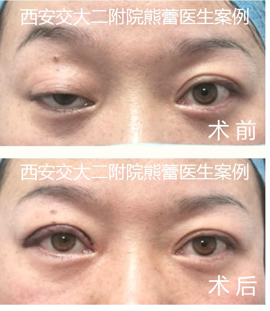 案例三:右眼重度上睑下垂矫正术后