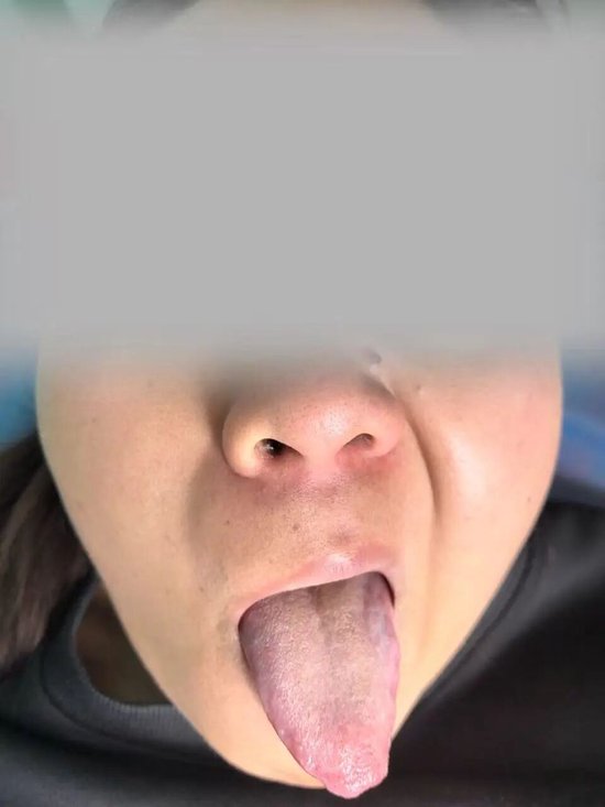 （右侧额纹消失、眼睑闭合不全、口角歪斜）