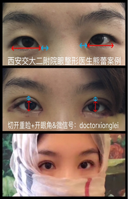图二:开眼角后,去掉下拉眼睑的阻力,能更方便的显露眼睛的神态
