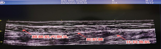 图上正常小腿三头肌纵切面声像图