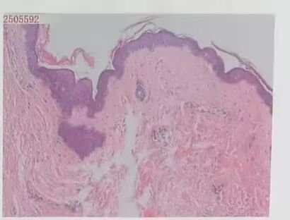 李奶奶病理结果回报