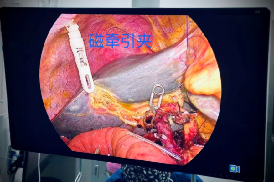 单孔腹腔镜三脏器手术术中模式