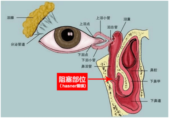 图 泪小管阻塞