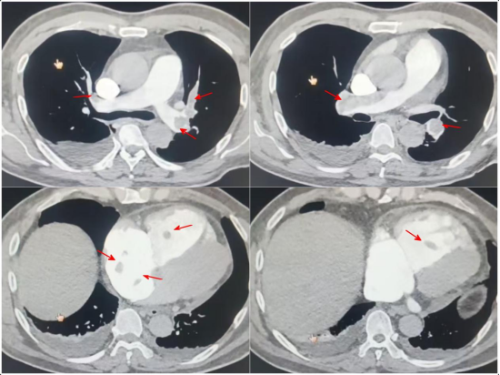 术前肺动脉CTA显示肺动脉及右心房、右心室内血栓